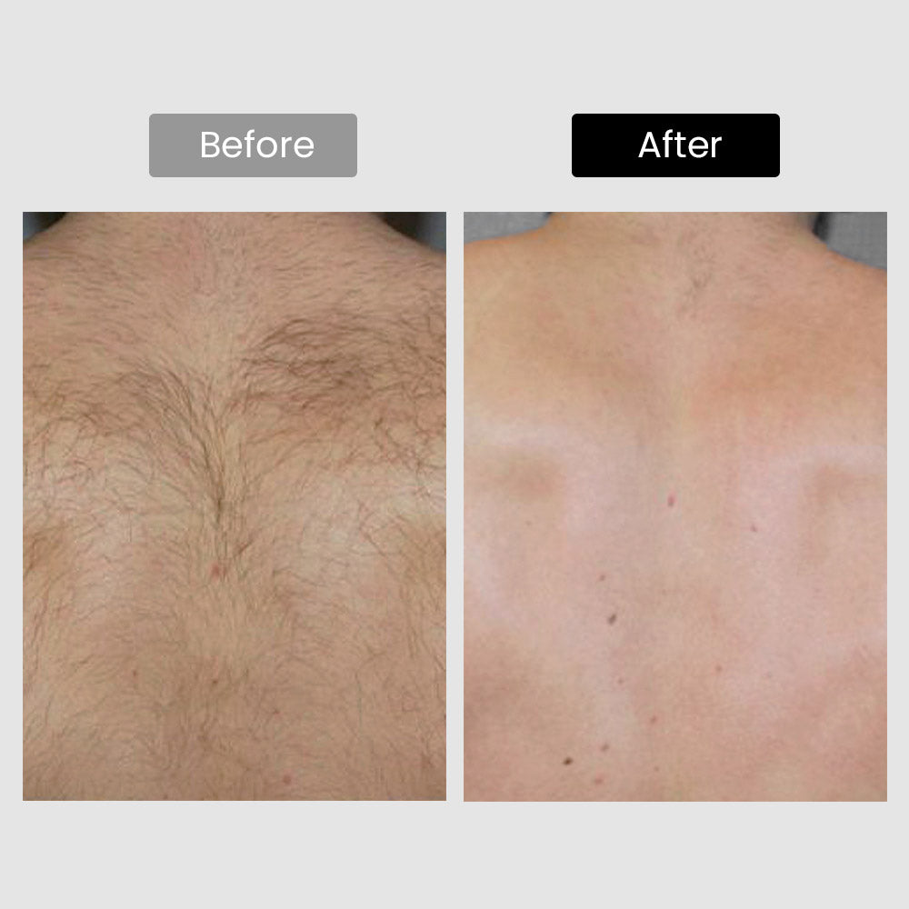 DermRays V8S *Edición mejorada* Depilación láser de diodo, enfriamiento de nivel profesional, apunta al cabello grueso con precisión