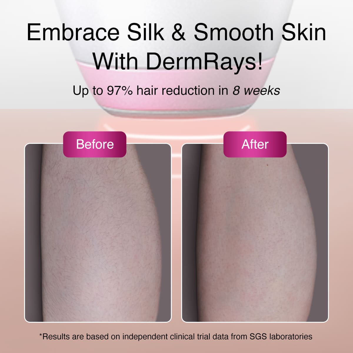 DermRays V6S Diode Laser Hair Removal, 1064nm, Specifically For Dark Skin