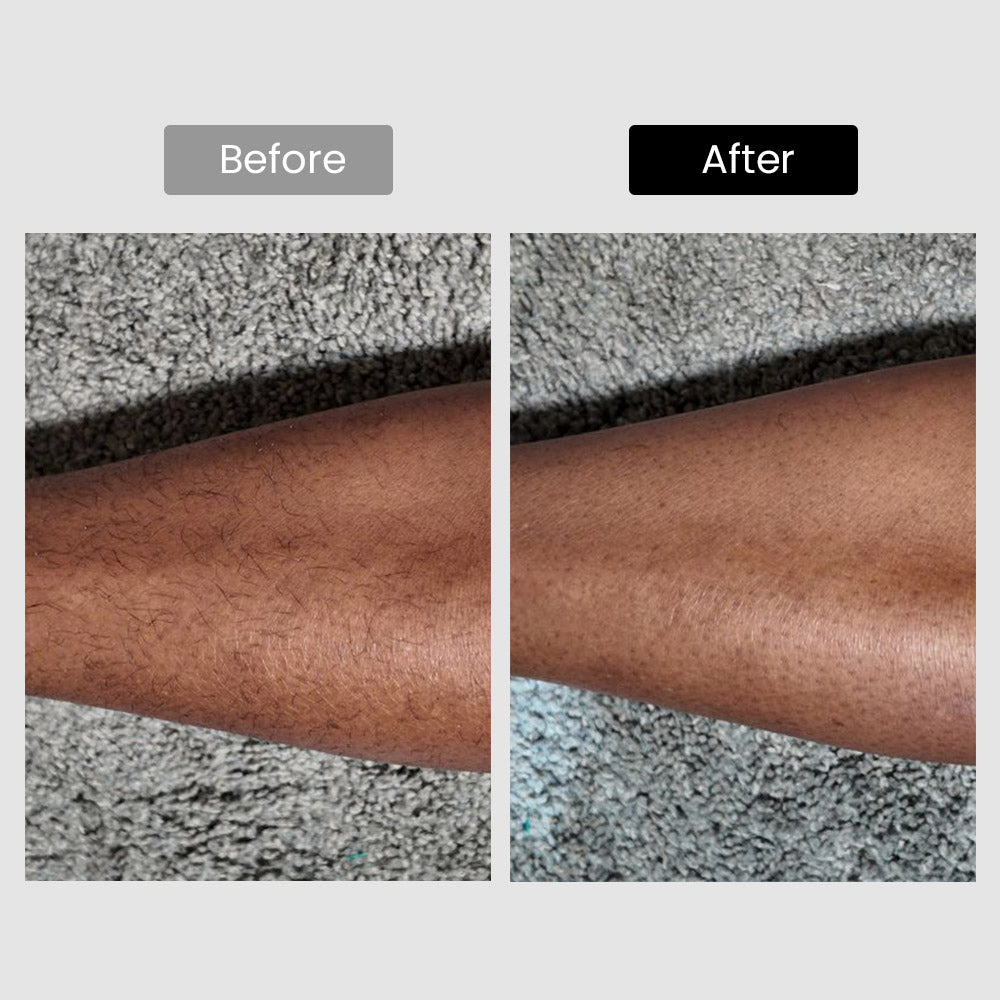 Depilación láser DermRays V6S, hasta 21J, 1064nm