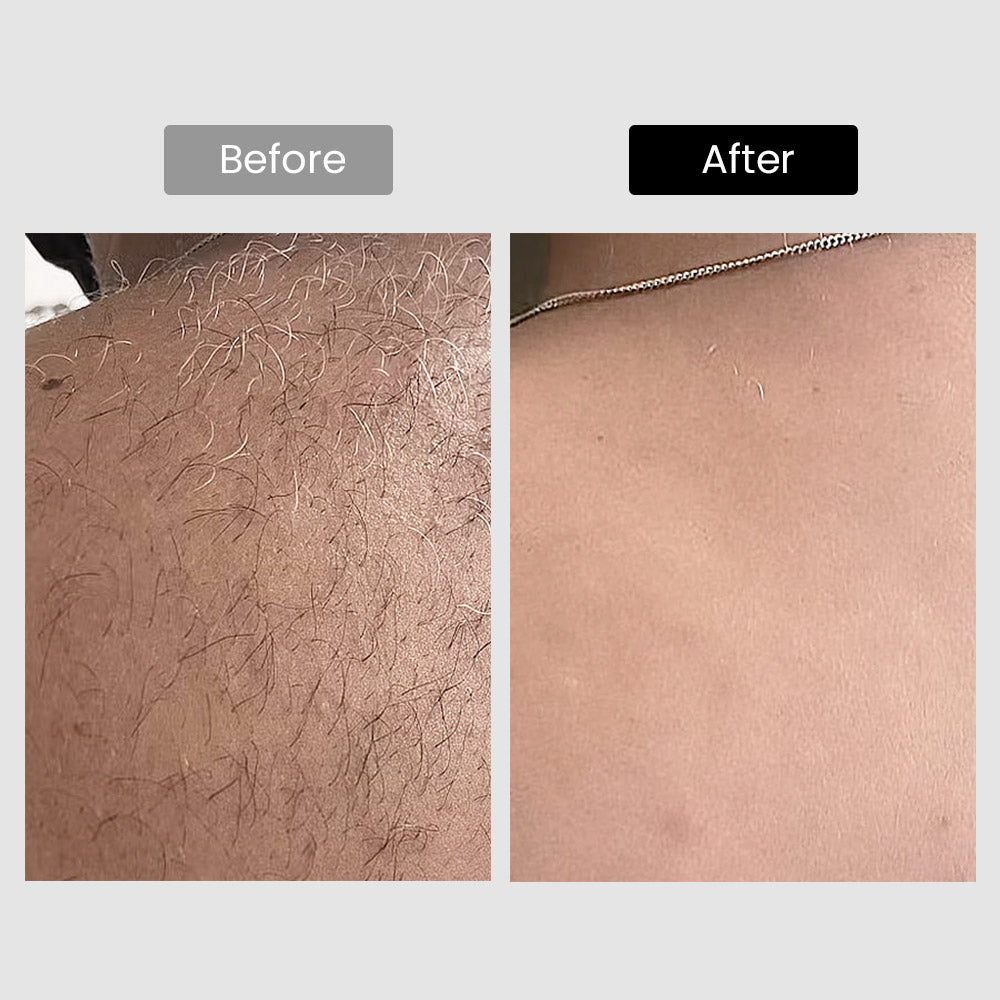 DermRays V8S Diode Laser Hair Removal, 810nm, Faster Results, Most Powerful