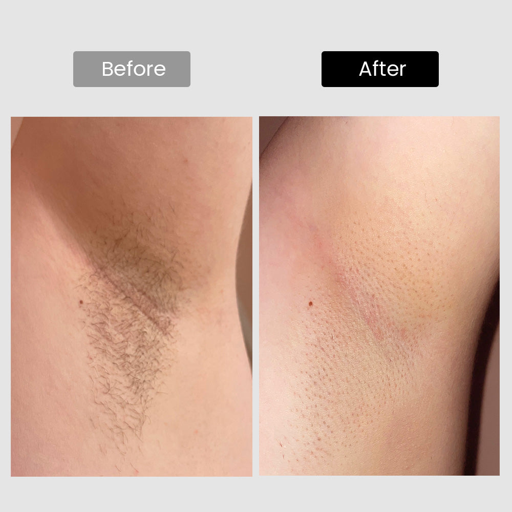 DermRays V8S *Enhanced Edition* Diode Laser Hair Removal, Pro-level cooling, Target Thick Hair with Precision