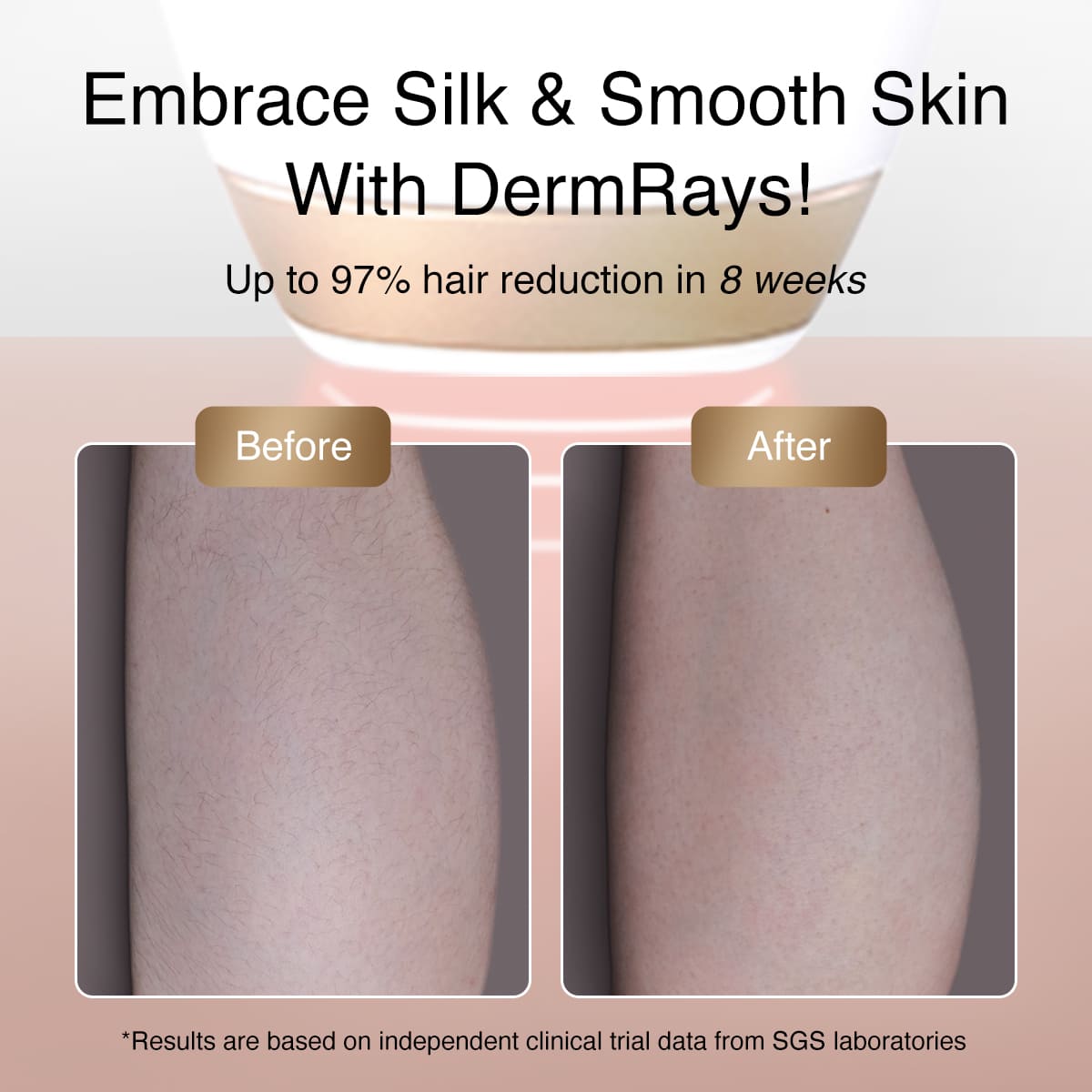 DermRays V4S Laser Hair Removal, Up to 21J, Specifically For Sensitive Skin
