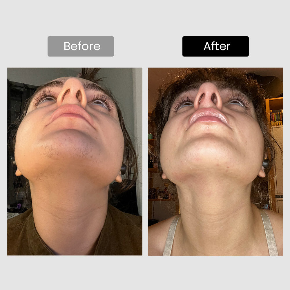 FDA Approved 810nm Diode Laser Hair Removal for Whole Body at Home