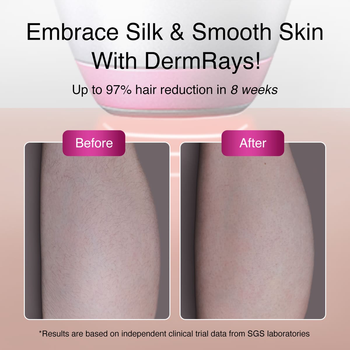 DermRays V6S Laser Hair Removal, 1064nm, Specifically For Deep Skin
