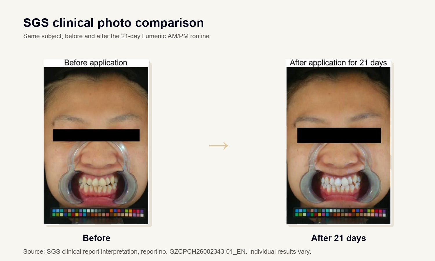 SGS clinical before and after tooth color comparison after 21 days